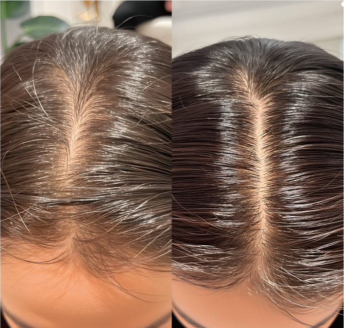 頭皮を元気にして育毛・ボリュームUP